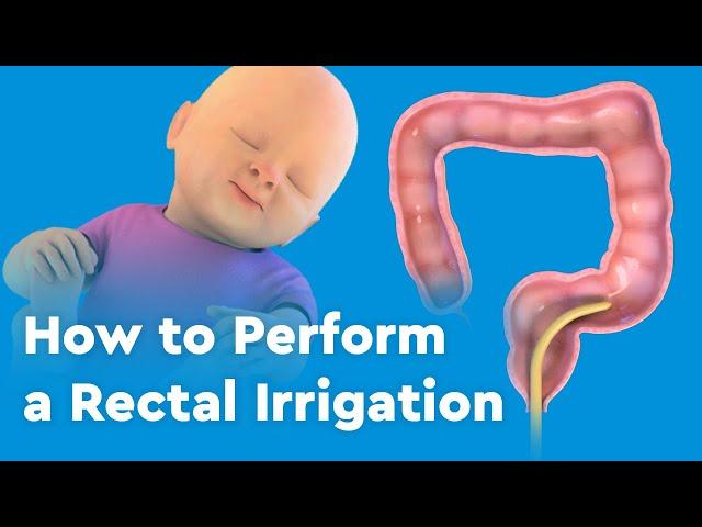 How to Perform a Rectal Irrigation for Patients with Hirschsprung Disease