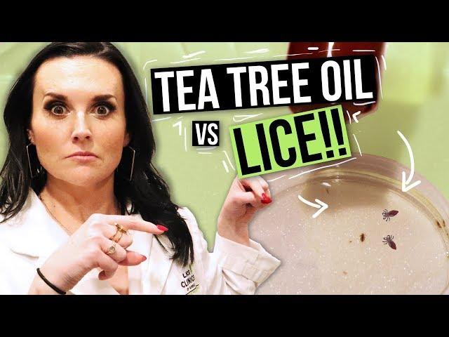 Removing LICE with TEA TREE OIL? - Watch this Before You Try!