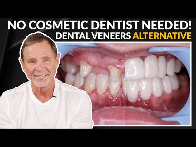 Cosmetic Dentist Alternative Option | Improve your Smile with Snap-On Dental Veneers!