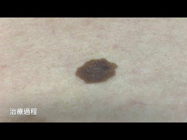 汽化雷射除表皮斑塊/痣/老人斑 美麗新城診所莊禮謙醫師 CO2 laser, nevus, seb keratosis removal