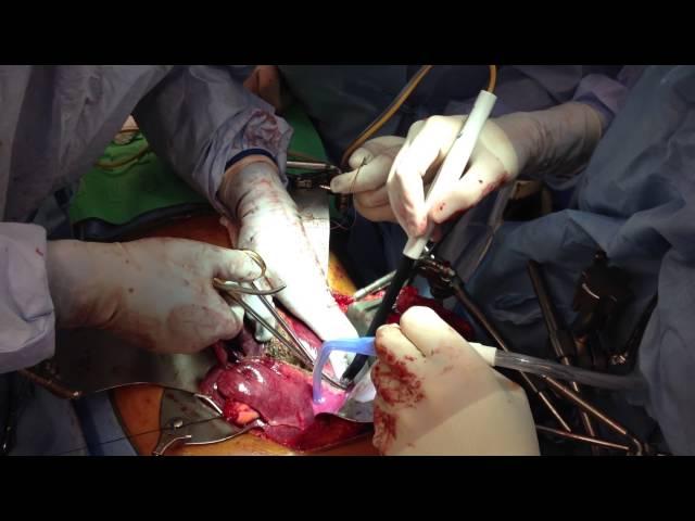 Bloodless Medicine and Surgery Liver Resection