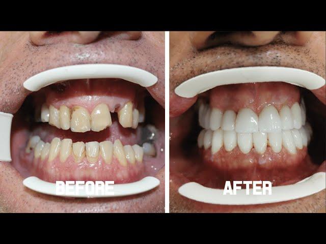 Zirconium Crowns (Smile Makeover) - James Jason From the U.K