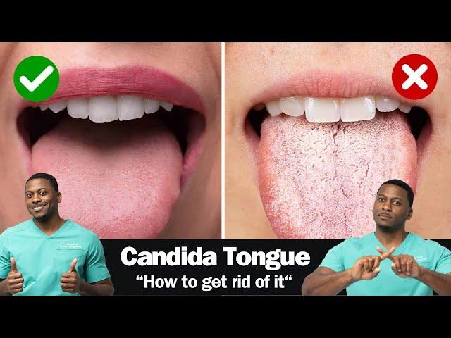 How To Fix A CANDIDA Yeast Overgrowth - Including Best Anti-fungal Herbs