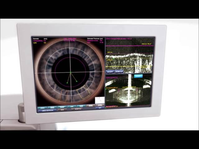 Bladeless Laser Cataract Surgery at The Eye Associates