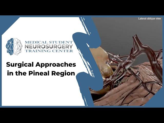 Surgical Approaches in the Pineal Region