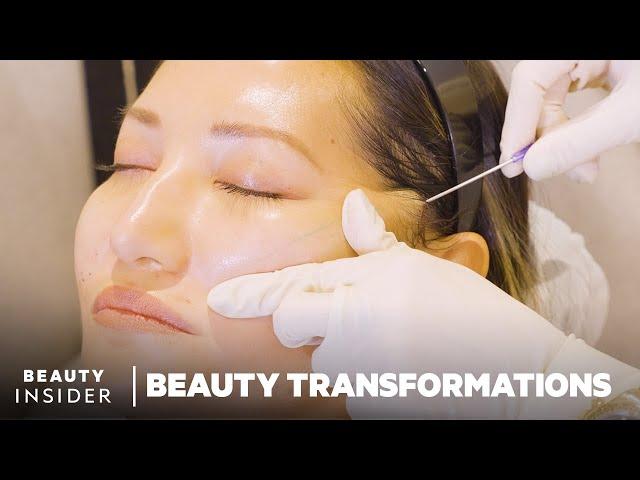 How Nonsurgical Face-Lifts Work With PDO Threads | Beauty Transformations | Insider Beauty