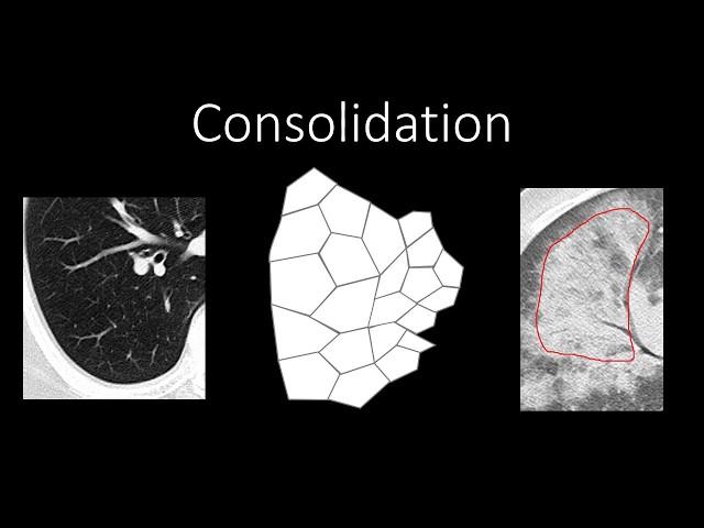 Chest Radiology - Patterns - Airspace