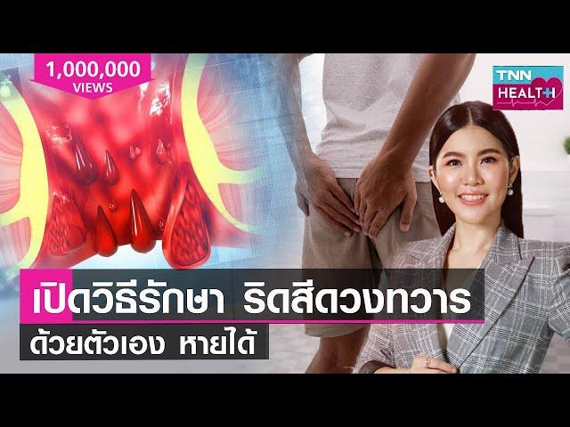 เปิดวิธีรักษา ริดสีดวงทวาร ด้วยตัวเอง หายได้! : TNN Health