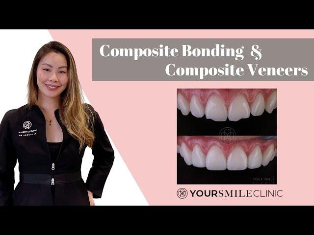 What is Composite Bonding and Composite Veneers? What you need to know before you have treatment!