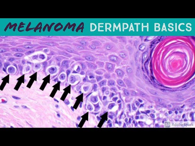 Melanoma vs Nevus: Microscopic Clues for Malignancy Explained in 5 Minutes