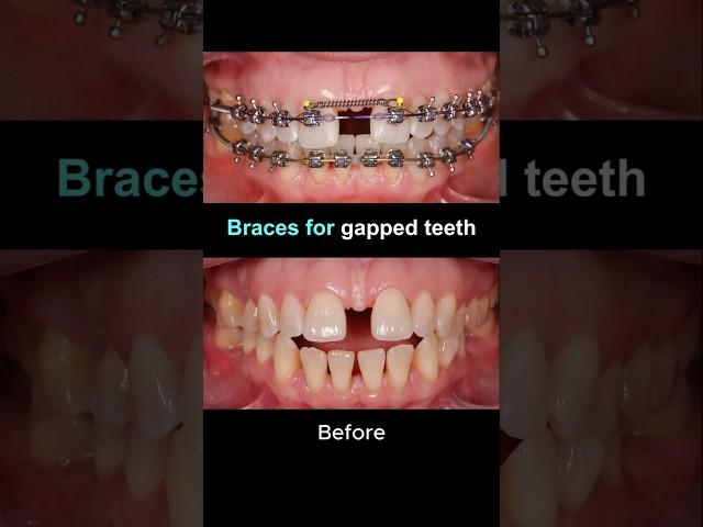 Braces for gapped teeth #braces #dentist #orthodontist
