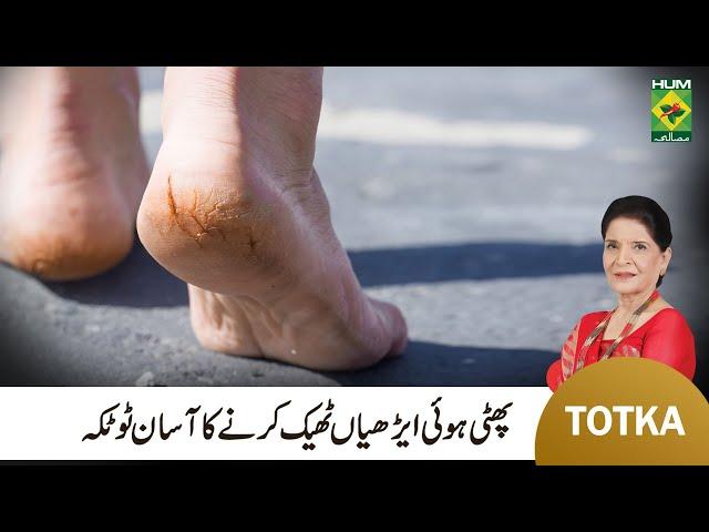 Zubaida Apa Totkay | How to Treat Cracked Ankles & Heels | Remove Quick Cracked Heels & Ankles