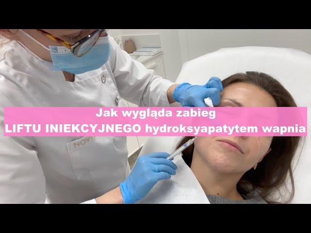 Jak wygląda zabieg LIFTU INIEKCYJNEGO HYDROKSYAPATYTEM WAPNIA