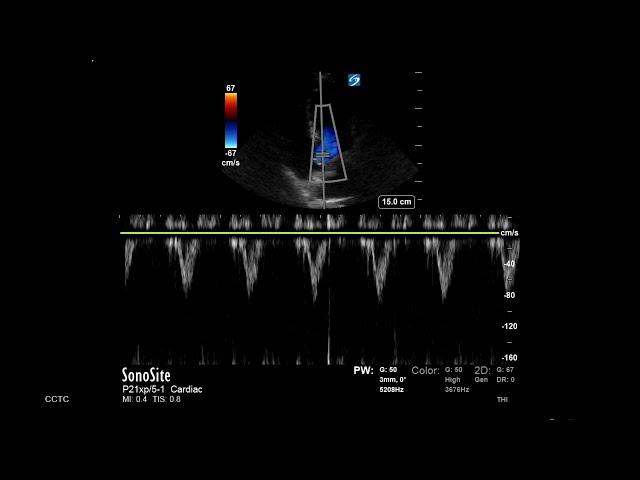 How to... Measure LVOT VTI