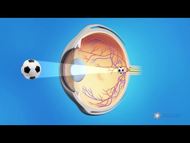 What are cataracts?