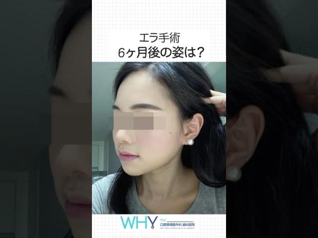 エラ手術から6ヶ月が経つと？