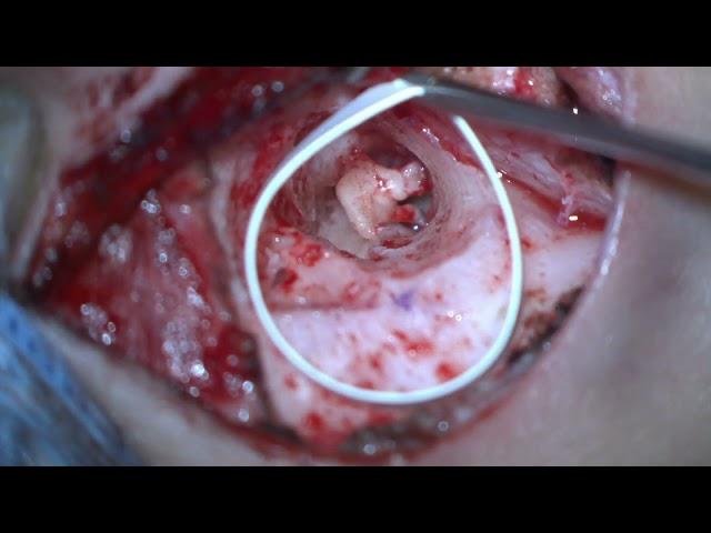 Microtia atresia ear canal reconstruction