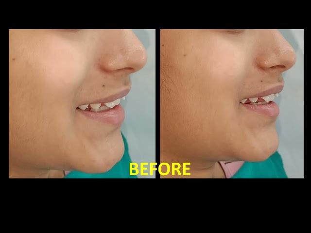 BRACES IN DELHI- BEST & ECONOMICAL, Metal Braces are Cheap and work well too. BANDHU DENTAL CLINIC