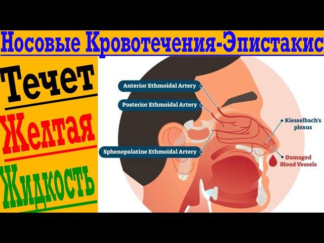 Носовые кровотечения! Почему течет кровь или желтая жидкость из носа! Эпистакис!