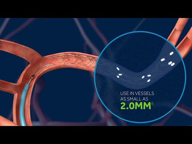 Medtronic Solitaire™ X Animation 2019