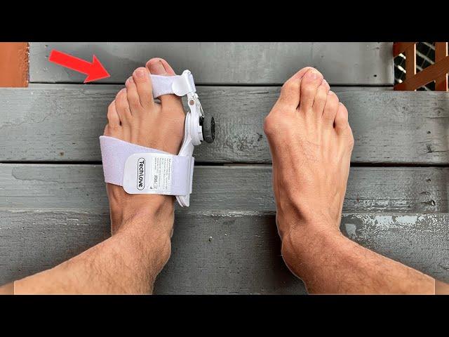 I Tried a Bunion Corrector: Here's What Happened...