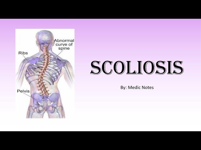 [Ortho] Scoliosis - postural & structural, Cobb's angle, Risser's sign, treatment