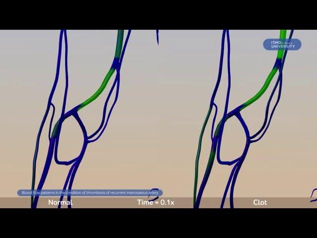 Thrombosis of Recurrent Interosseous Artery