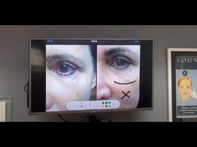 Agnes Chicago | New treatment to help wrinkle under the eyes | Dr. Kovak Oak Brook Rockford Chicago