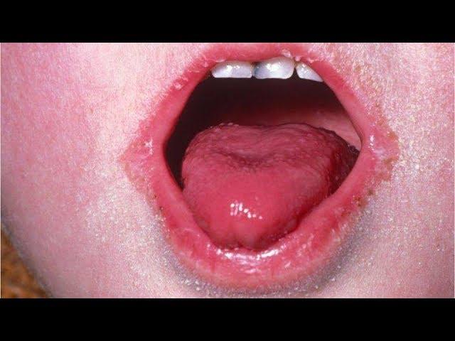 What is scarlet fever?