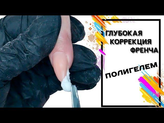 Глубокая коррекция френча Полигелем