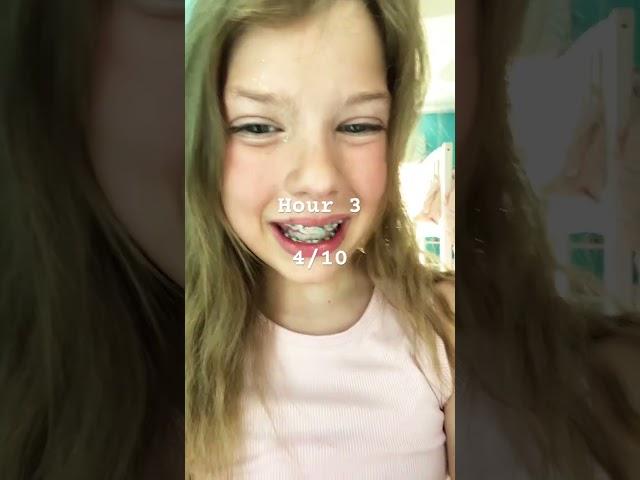 How my braces feel on the first day
