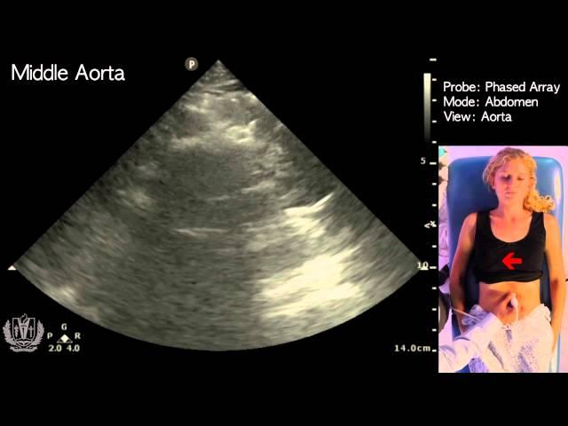 How to Perform Ultrasound of the Aorta -STEP by STEP