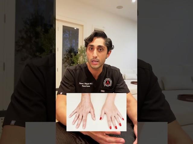 Are bulging hand veins a medical issue?