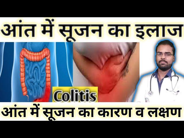 आंत में सूजन का इलाज !Aant me sujan ka ilaj ! Aat me sujan ke lakshan! Colitis ka  gharelu ilaj !