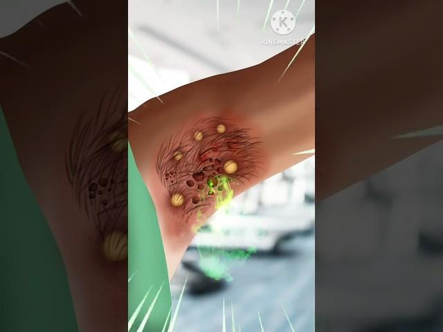 ASMR infected underarms cleaning treatment  #asmr #animation #hindiversion #viral #shorts