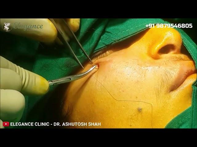 Maxilla Fat Grafting Surgery in Surat - Live Video