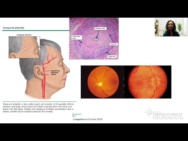 Virtual Resident Education Lecture Series: Headache Medicine - American Academy of Neurology