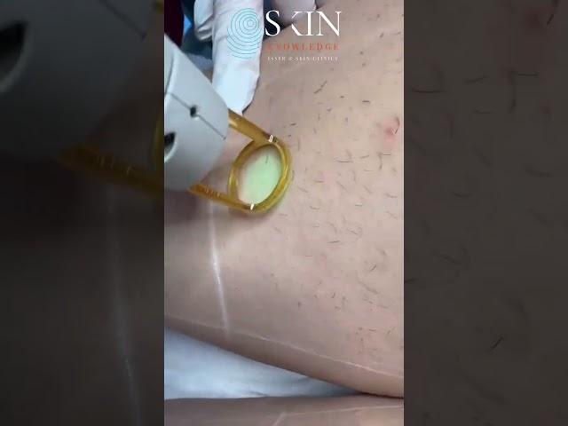 Full Legs Laser Hair Removal