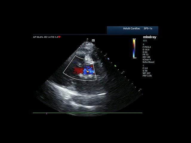 How to...Assess AR by Color Doppler