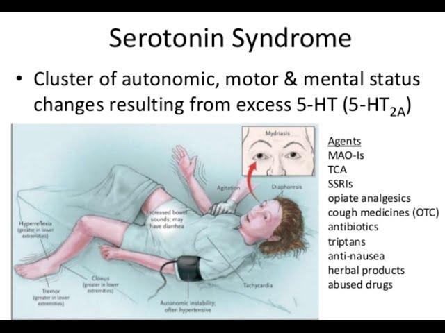 Serotonin Syndrome