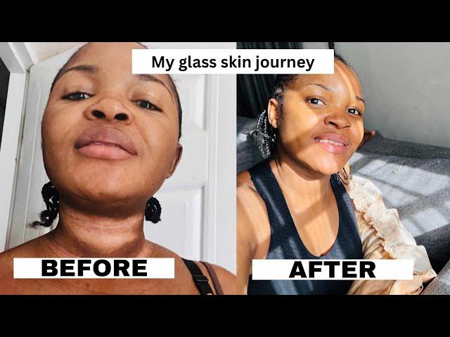 How I got rid of stubborn hyperpigmentation and my skincare products