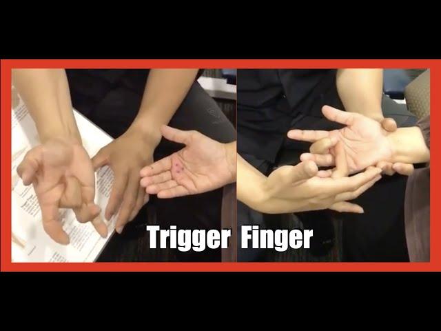 Trigger Finger - Some tips and advice from Master Chris Leong on DIY at home method.