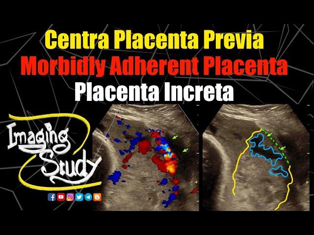 Placenta Previa | Placenta Increta | Morbidly Adherent Placenta || Ultrasound || Doppler || Case 283