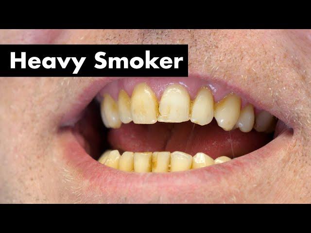 Cleaning Smoker's Teeth with Heavy Stain | Teeth Cleaning