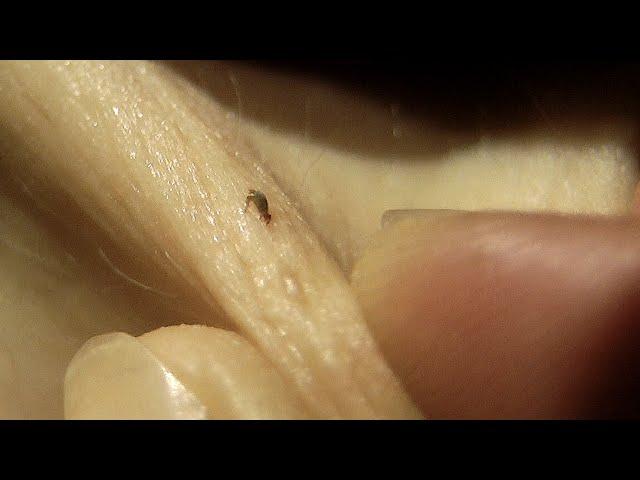 How to remove ticks from skin painlessly, no pulling! No special tools!
