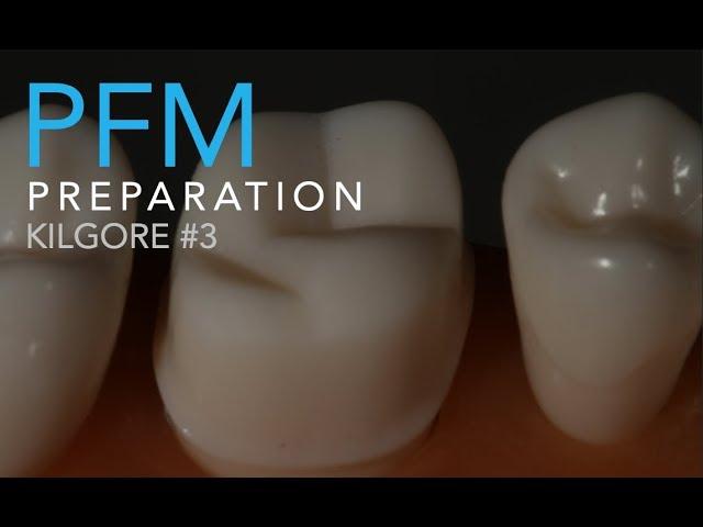 Molar Ceramo-Metal Preparation | How to Prepare a PFM On a Maxillary Molar