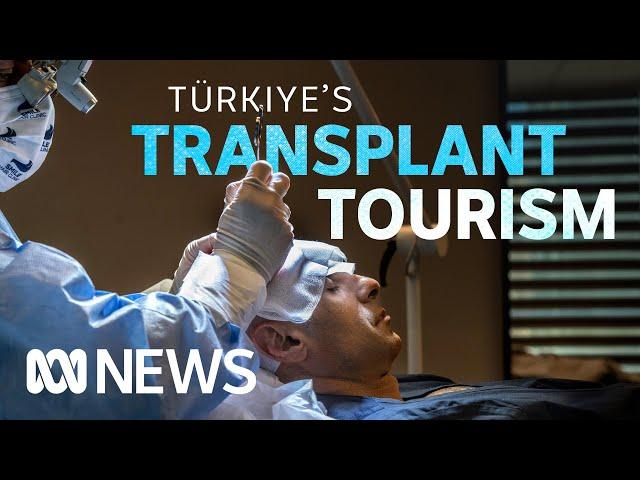 Türkiye’s thriving hair transplant industry | ABC News