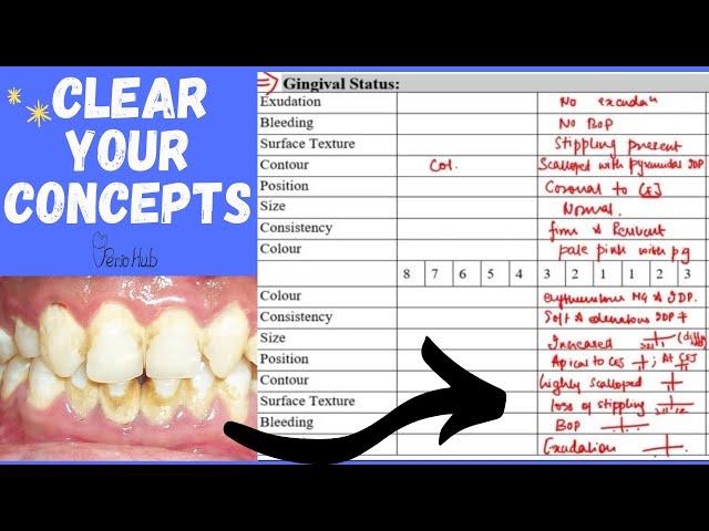 Examination Of The Gingival Status ‖ Health VS Gingival Disease ‖ Gingival Considerations ‖ PerioHub