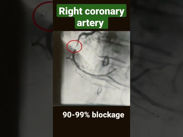 Right coronary artery with 80-90%, 90-99% and 100% blockage ( angiography) #shorts