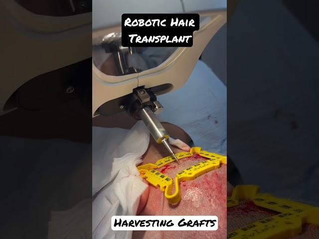 Robotic Hair Transplant using the Artas iX. Now in Orange County. Harvesting grafts